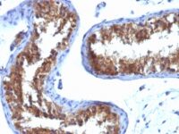 Staining with Mouse monoclonal MVP [Clone 1032] antibody in formalin-fixed paraffin-embedded human testicular carcinoma.